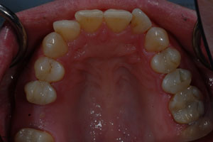 bonding cosmetic invisalign before august posted